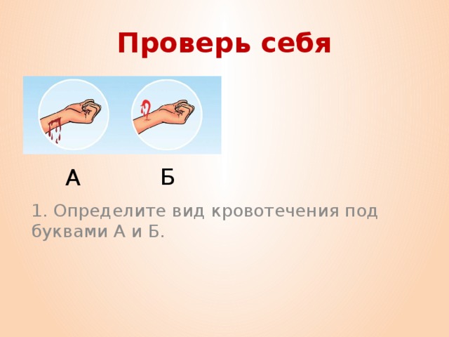 Проверь себя Б А 1. Определите вид кровотечения под буквами А и Б.