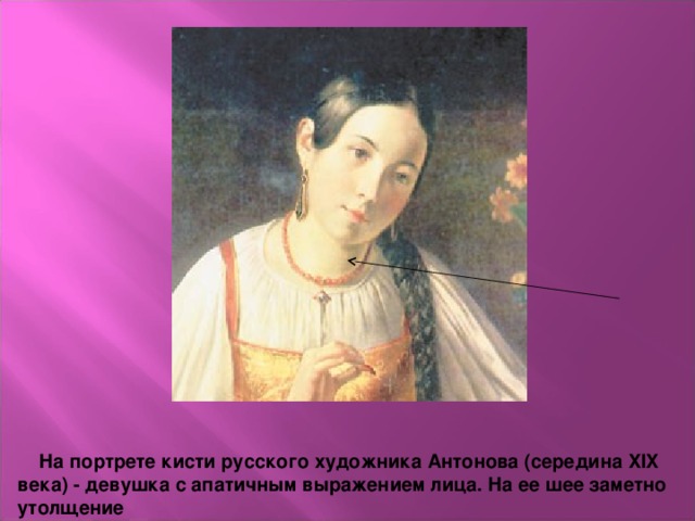 На портрете кисти русского художника Антонова (середина XIX века) - девушка с апатичным выражением лица. На ее шее заметно утолщение