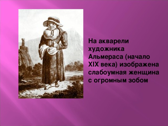 На акварели художника Альмераса (начало XIX века) изображена слабоумная женщина с огромным зобом