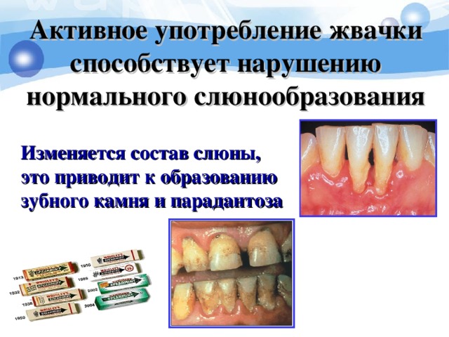 Активное употребление жвачки способствует нарушению нормального слюнообразования  Изменяется состав слюны, это приводит к образованию зубного камня и парадантоза