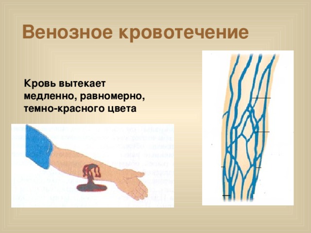 Венозное кровотечение Кровь вытекает медленно, равномерно, темно-красного цвета