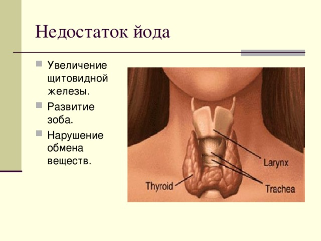 Увеличение щитовидной железы. Развитие зоба. Нарушение обмена веществ.