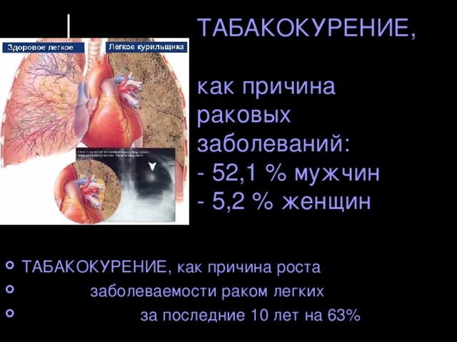 ТАБАКОКУРЕНИЕ,  как причина раковых заболеваний:  - 52,1 % мужчин  - 5,2 % женщин