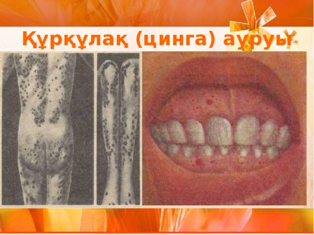 Құрқұлақ (цинга) ауруы