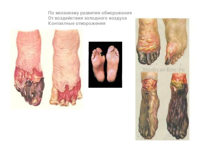 По механизму развития обморожения От воздействия холодного воздуха Контактные отморожения