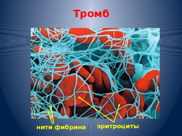 Тромб эритроциты нити фибрина