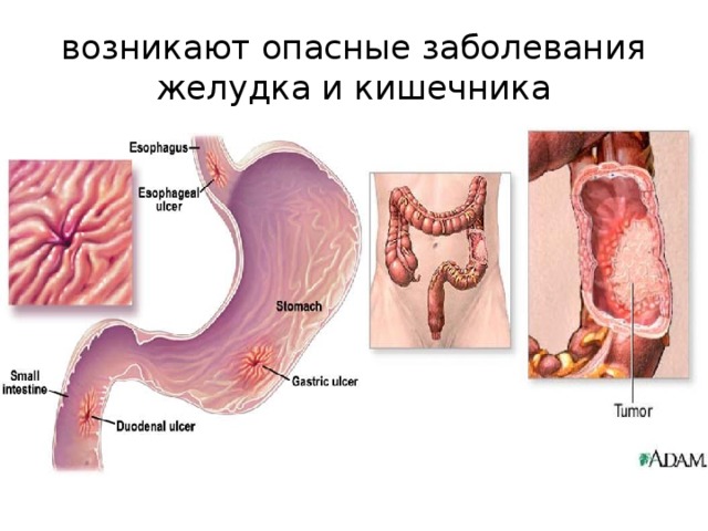 возникают опасные заболевания желудка и кишечника