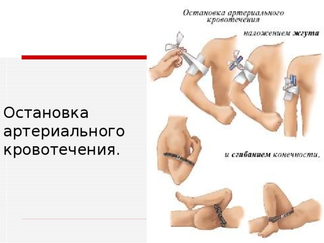 Остановка артериального кровотечения. При артериальном кровотечении сосуд сдавливают выше места его повреждения, а при кровотечении из вены - ниже раны. Для этого нужно знать схему магистральных артериальных сосудов и места их пальцевого прижатия 3