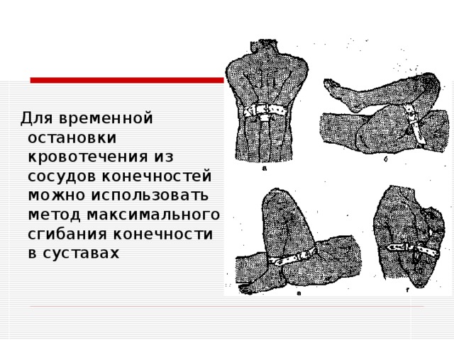 Для временной остановки кровотечения из сосудов конечностей можно использовать метод максимального сгибания конечности в суставах Для временной остановки кровотечения из сосудов конечностей можно использовать метод максимального сгибания конечности в суставах (рис. 4). При кровотечении из сосудов плеча руку заводят за спину и фиксируют ее повязкой. Если кровоточат сосуды предплечья, руку сгибают в локтевом суставе. При кровотечении из ран голени или стопы ногу сгибают максимально в коленном суставе и, придав конечности такое положение, ее надежно прибинтовывают 3