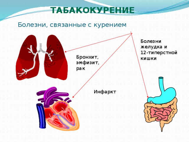 табакокурение Болезни, связанные с курением Болезни желудка и 12-типерстной кишки Бронхит, эмфизит, рак Инфаркт