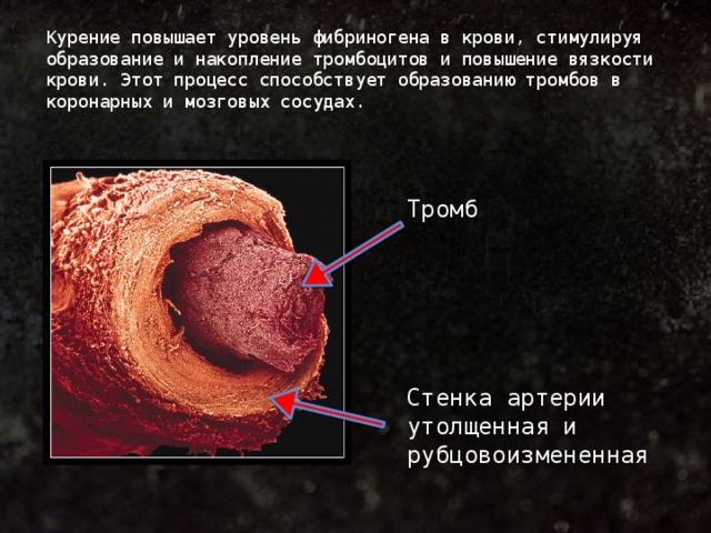 Курение повышает уровень фибриногена в крови, стимулируя образование и накопление тромбоцитов и повышение вязкости крови. Этот процесс способствует образованию тромбов в коронарных и мозговых сосудах. Тромб Стенка артерии утолщенная и рубцовоизмененная