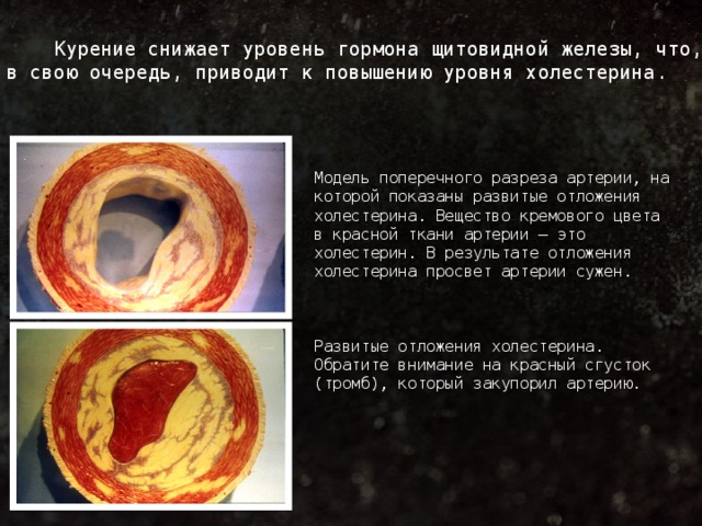 Курение снижает уровень гормона щитовидной железы, что, в свою очередь, приводит к повышению уровня холестерина. Модель поперечного разреза артерии, на которой показаны развитые отложения холестерина. Вещество кремового цвета в красной ткани артерии — это холестерин. В результате отложения холестерина просвет артерии сужен. Развитые отложения холестерина. Обратите внимание на красный сгусток (тромб), который закупорил артерию.  