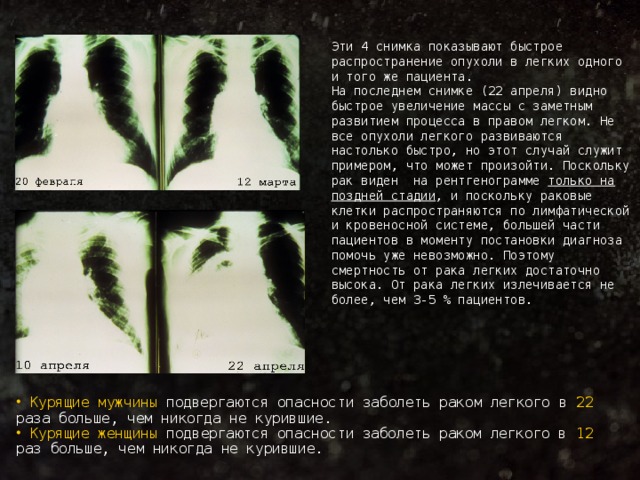 Эти 4 снимка показывают быстрое распространение опухоли в легких одного и того же пациента. На последнем снимке (22 апреля) видно быстрое увеличение массы с заметным развитием процесса в правом легком. Не все опухоли легкого развиваются настолько быстро, но этот случай служит примером, что может произойти. Поскольку рак виден на рентгенограмме только на поздней стадии , и поскольку раковые клетки распространяются по лимфатической и кровеносной системе, большей части пациентов в моменту постановки диагноза помочь уже невозможно. Поэтому смертность от рака легких достаточно высока. От рака легких излечивается не более, чем 3-5 % пациентов.