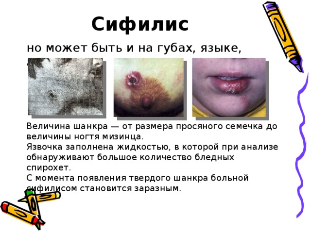 Сифилитический шанкр на губе фото