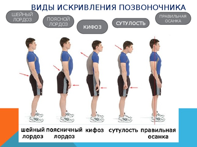Виды искривления позвоночника ШЕЙНЫЙ ЛОРДОЗ ПРАВИЛЬНАЯ ОСАНКА ПОЯСНОЙ ЛОРДОЗ СУТУЛОСТЬ КИФОЗ