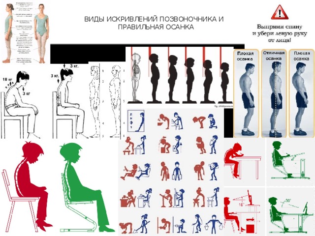 ВИДЫ ИСКРИВЛЕНИЙ ПОЗВОНОЧНИКА И  ПРАВИЛЬНАЯ ОСАНКА