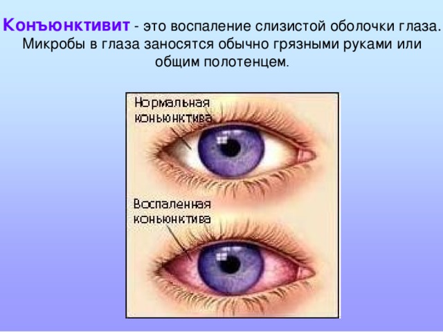 Конъюнктивит - это воспаление слизистой оболочки глаза. Микробы в глаза заносятся обычно грязными руками или общим полотенцем .