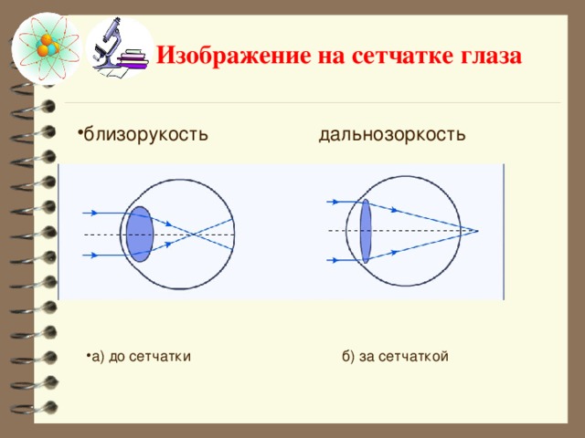 Изображение на сетчатке глаза близорукость дальнозоркость     а) до сетчатки    б) за сетчаткой