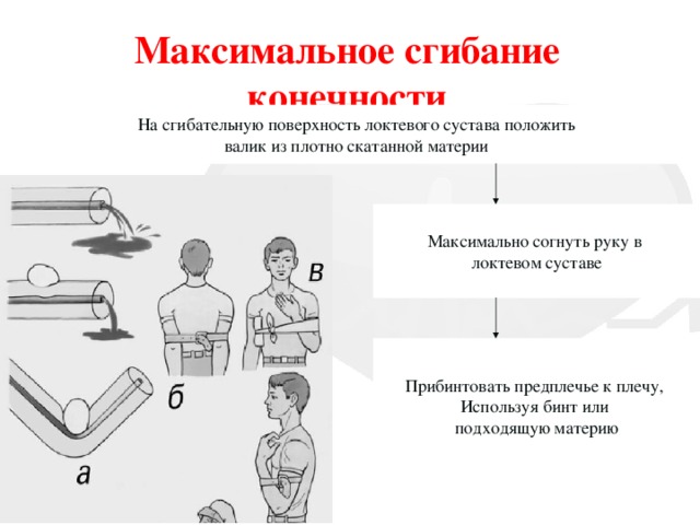 Максимальное сгибание конечности На сгибательную поверхность локтевого сустава положить валик из плотно скатанной материи Максимально согнуть руку в локтевом суставе Прибинтовать предплечье к плечу, Используя бинт или подходящую материю