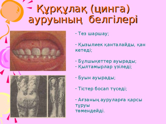 Құрқұлақ (цинга) ауруының белгілері  Тез шаршау;  Қызылиек қанталайды, қан кетеді;  Бұлшықеттер ауырады;  Қылтамырлар үзіледі;  Буын ауырады;  Тістер босап түседі;  Ағзаның ауруларға қарсы тұруы төмендейді. 20