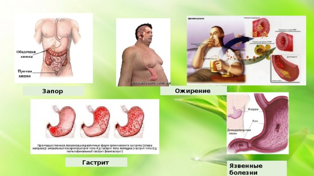 Ожирение  Запор Гастрит Язвенные болезни