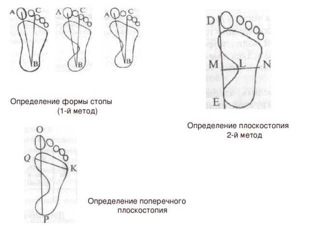 Определение формы стопы (1-й метод) Определение плоскостопия 2-й метод Определение поперечного  плоскостопия