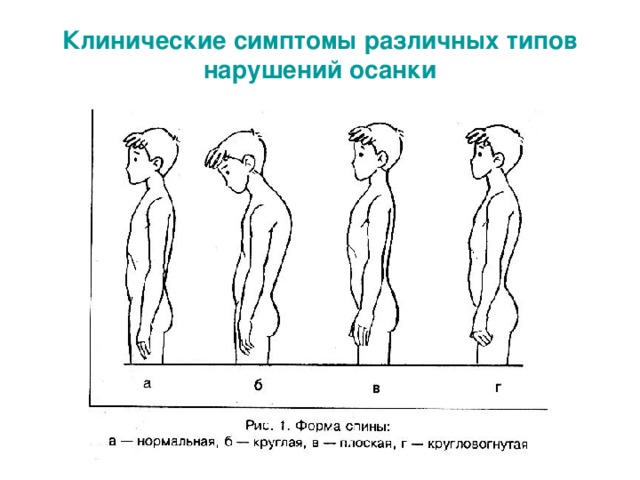 Клинические симптомы различных типов нарушений осанки