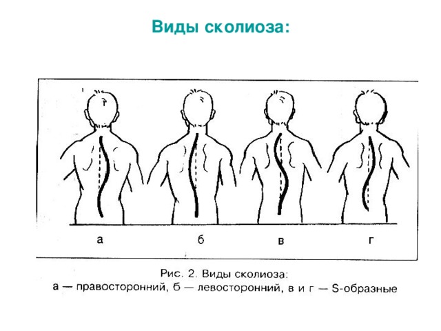 Виды сколиоза: