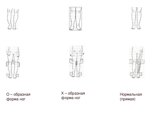 Х – образная форма ног О – образная форма ног Нормальная (прямая)