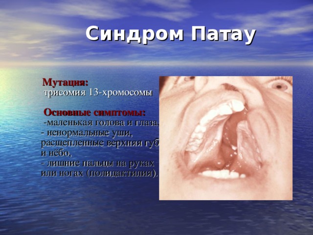 Синдром Патау     Мутация:   трисомия 13-хромосомы    Основные симптомы:  -маленькая голова и глаза,  - ненормальные уши, расщепленные верхняя губа и нёбо,  - лишние пальцы на руках или ногах (полидактилия).