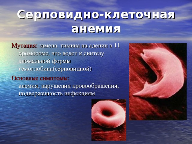 Серповидно-клеточная анемия Мутация: замена тимина на аденин в 11 хромосоме, что ведет к синтезу аномальной формы гемоглобина(серповидной) Основные симптомы:  анемия, нарушения кровообращения, подверженность инфекциям