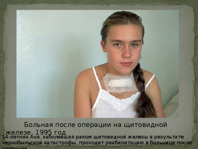 Больная после операции на щитовидной железе, 1995 год 14-летняя Аня, заболевшая раком щитовидной железы в результате чернобыльской катастрофы, проходит реабилитацию в больнице после операции.