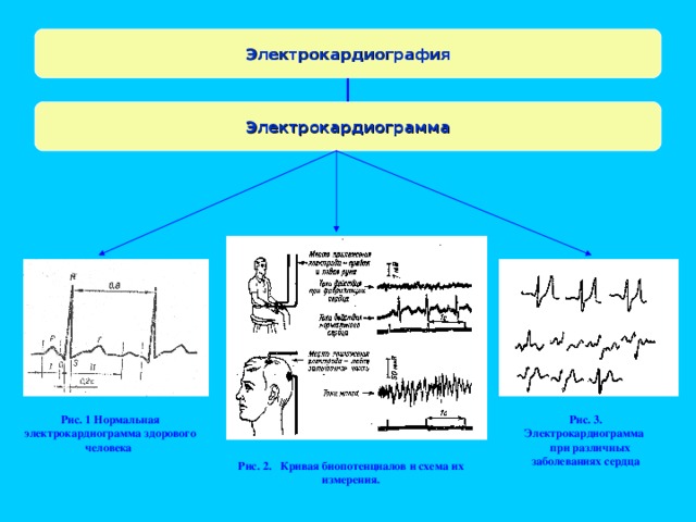 Электрокардиография Электрокардиограмма Рис. 1 Нормальная электрокардиограмма здорового человека Рис. 3. Электрокардиограмма  при различных заболеваниях сердца Рис. 2. Кривая биопотенциалов и схема их измерения.