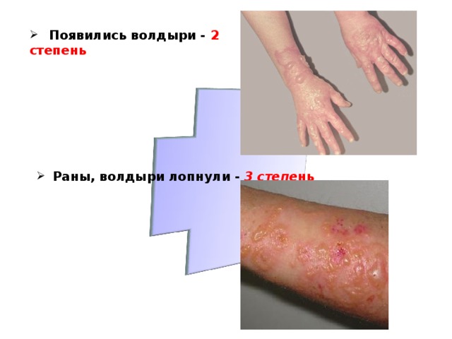 Появились волдыри - 2 степень    Раны, волдыри лопнули - 3 степе нь