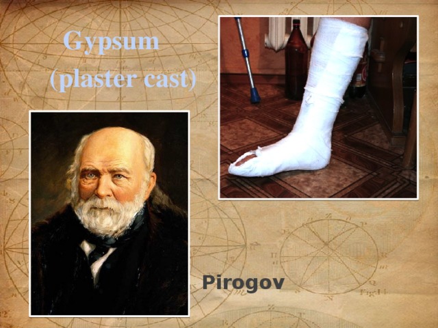 Gypsum (plaster cast) Pirogov