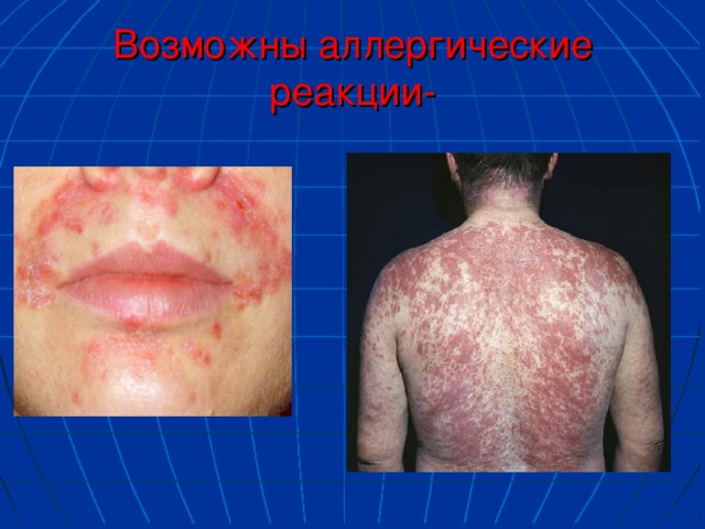 Аллергические реакции на коже фото и описание