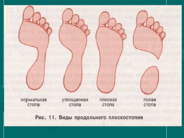 Рассмотрите рисунок с изображением стопы человека как называют нарушение формы стопы