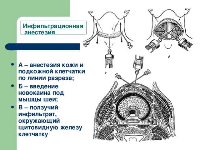 Инфильтрационная  анестезия