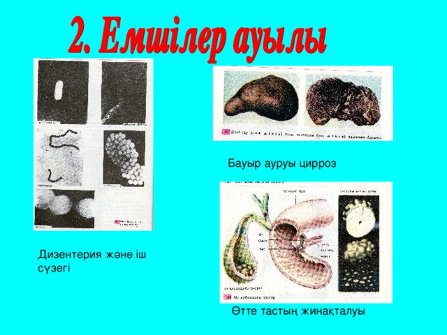 Бауыр ауруы цирроз Дизентерия және іш сүзегі Өтте тастың жинақталуы