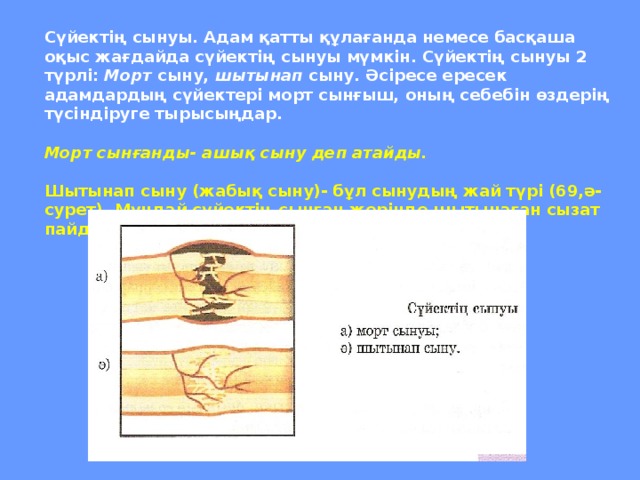 Сүйектің сынуы. Адам қатты құлағанда немесе басқаша оқыс жағдайда сүйектің сынуы мүмкін. Сүйектің сынуы 2 түрлі: Морт сыну, шытынап сыну. Әсіресе ересек адамдардың сүйектері морт сынғыш, оның себебін өздерің түсіндіруге тырысыңдар.  Морт сынғанды- ашық сыну деп атайды.  Шытынап сыну (жабық сыну)- бұл сынудың жай түрі (69,ә-сурет). Мұндай сүйектің сынған жерінде шытынаған сызат пайда болады.