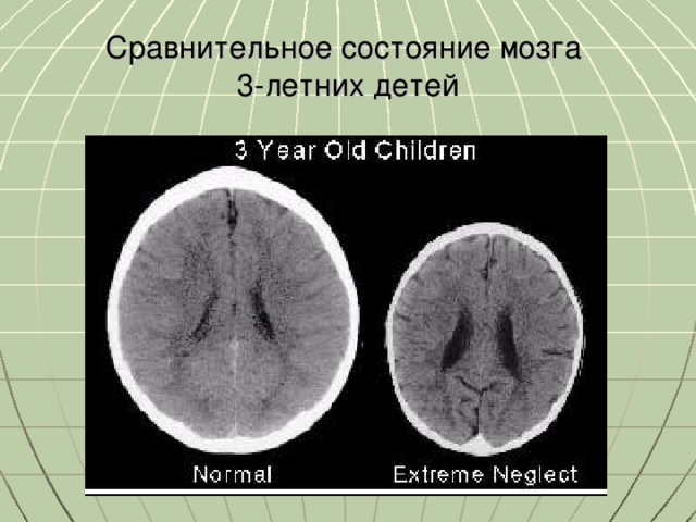 Сравнительное состояние мозга  3-летних детей