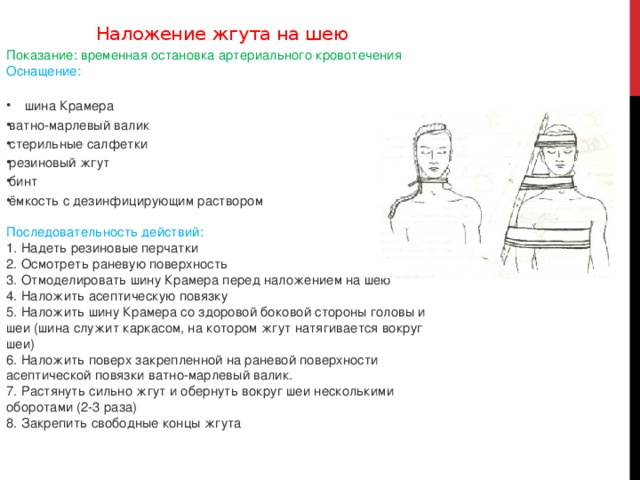 Наложение жгута на шею Показание: временная остановка артериального кровотечения  Оснащение: