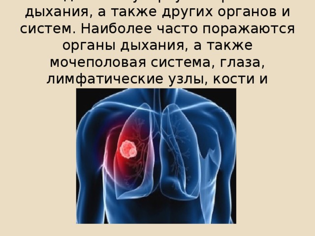 Выделяют туберкулёз органов дыхания, а также других органов и систем. Наиболее часто поражаются органы дыхания, а также мочеполовая система, глаза, лимфатические узлы, кости и суставы, кожа.
