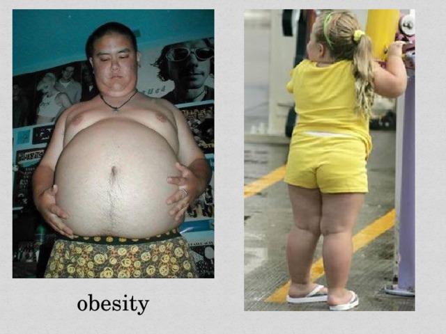 obesity