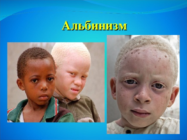 Альбинизм
