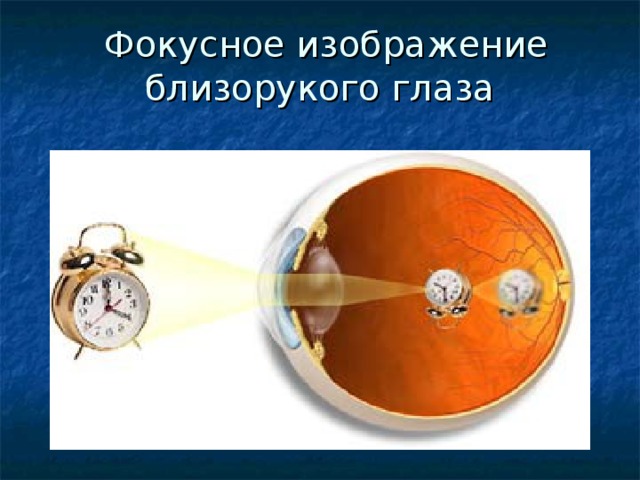 Фокусное изображение близорукого глаза