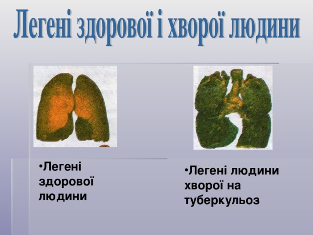 Легені здорової людини Легені людини хворої на туберкульоз