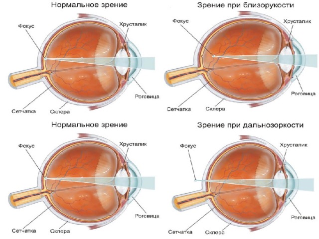 Изображения в близоруком глазу фокусируется