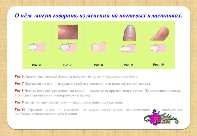 О чём могут говорить изменения на ногтевых пластинках. Рис.6 Сильно увеличенная лунка на всех ногтях руки — сердечная слабость. Рис.7 Дырчатый ноготь — нарушение работы селезенки или поджелудочной железы. Рис.8 Ноготь плоский, расщеплен на конце — характерен при наличии глистов. По-медицински говоря, это «глистная инвазия», «энтеробиоз» и прочее. Рис.9 Белые поперечные штрихи — недостаток цинка или кальция. Рис.10 Красная лунка — указывает на кардио-васкулярные, аутоиммунные или эндокринные проблемы, ревматические заболевания.