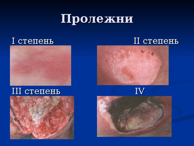 Пролежни І  степень ІІ степень ІІІ степень І V степень